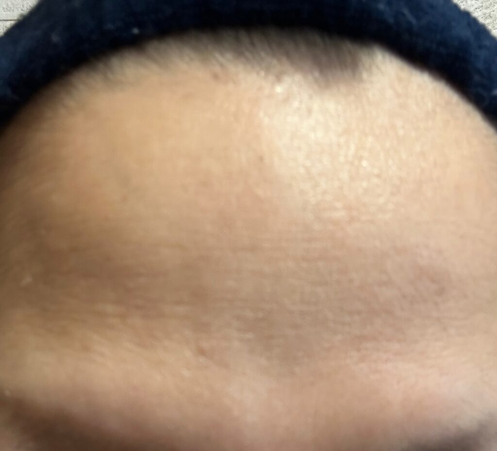 40代女性のおでこのシワ